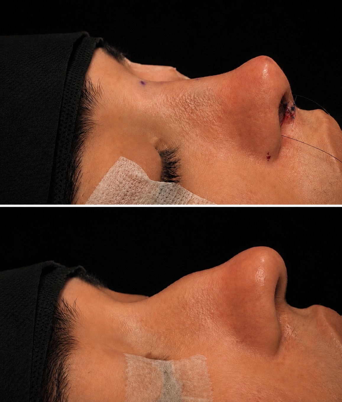 Rinoplastia — antes e depois