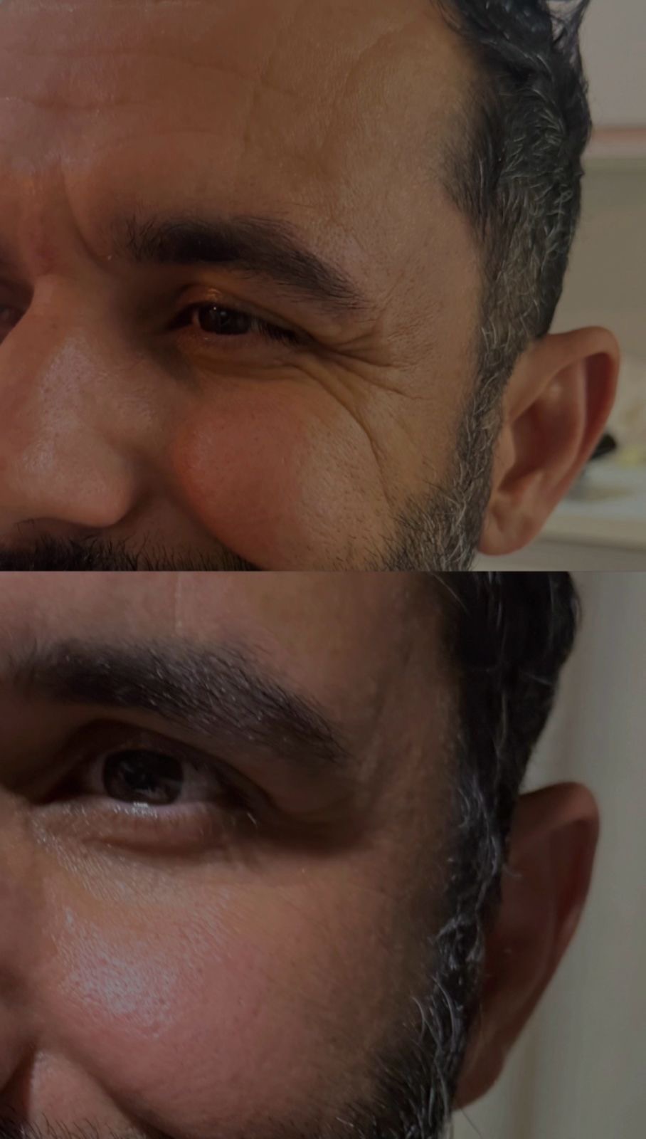 Toxina Botulínica — antes e depois
