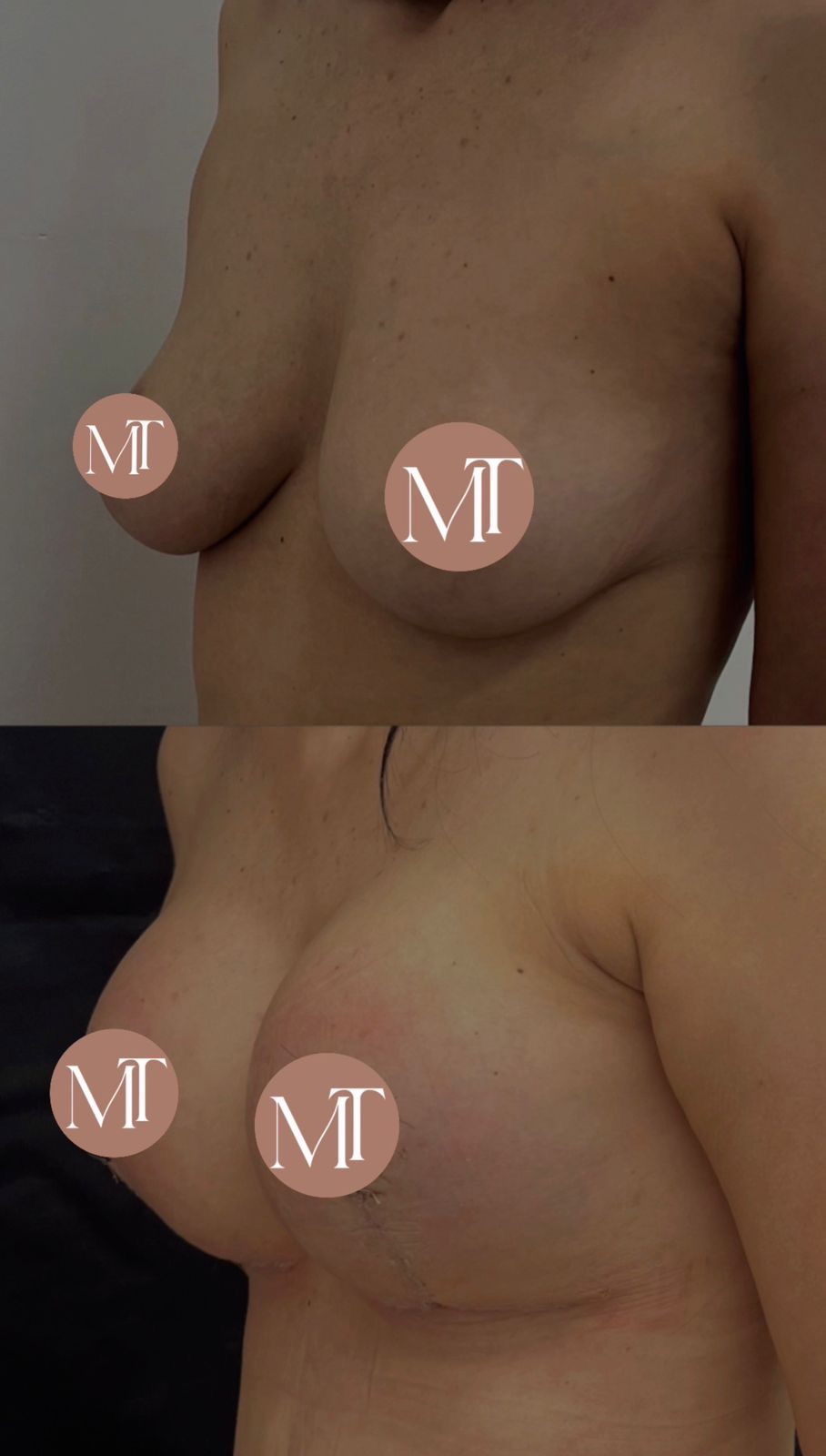 Mastopexia com Prótese — antes e depois